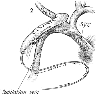 Subclavian Port-A-Cath