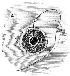 Urethral Caruncle Causes Symptoms And Treatment Urethral Caruncle Causes Symptoms And Treatment