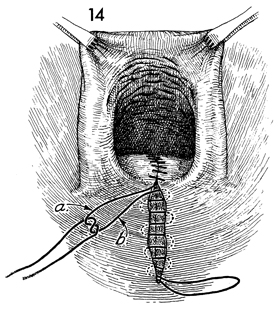 Posterior repair