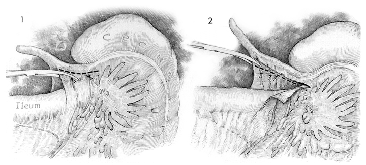 Appendectomy: Open Technique | Basicmedical Key