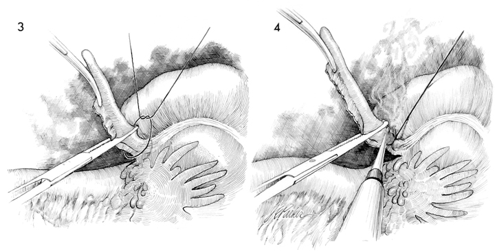 Different Techniques of Surgical Left Atrial Appendage Closure and Their  Efficacy: A Systematic Review