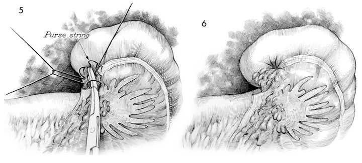 Modern surgery, general and operative . Fig. 733.—Macewens operation for  radical cure of inguinal hernia: A, Stripping of the sac: B,purse-string  suture; c, fastening the purse-string suture; D, passing, and E, tjdng,